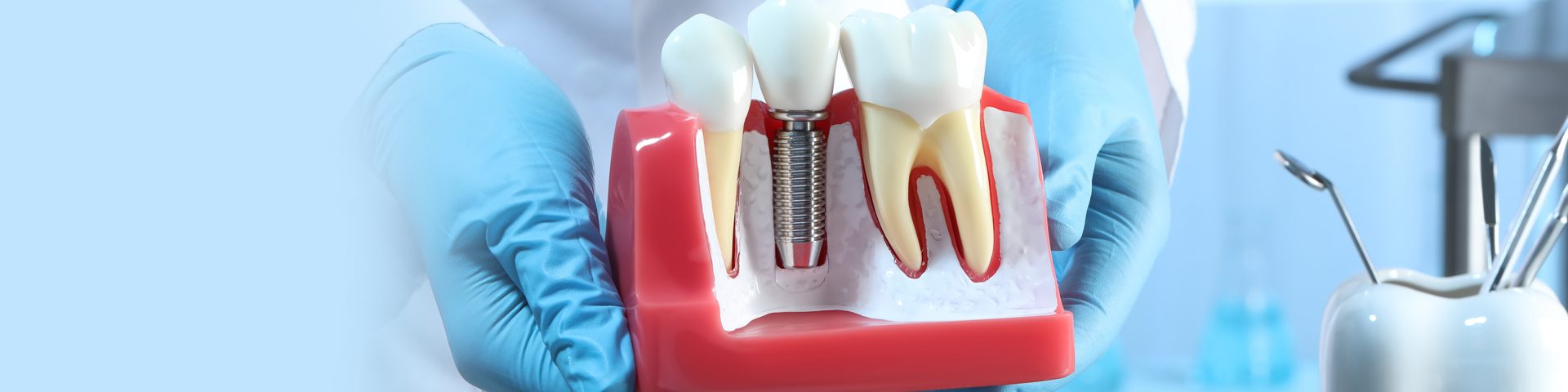 Dental Implants: An Effective Tooth Replacement Option